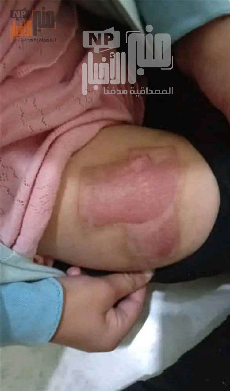 هكذا مارست ضده التعذيب..مشاهد محزنة يتعرض لها طفل في تعز من قبل زوجة والدهم الثانية (صور محزنة)