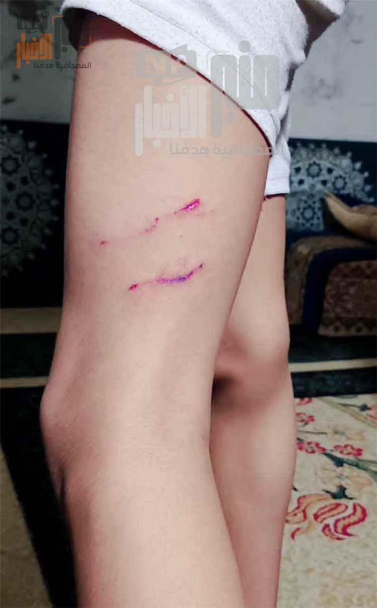 كلاب ضالة تهاجم طفلاً في تعز بعد خروجه من المسجد.. والحقنة بـ35 ألف ريال رغم صرفها مجانا