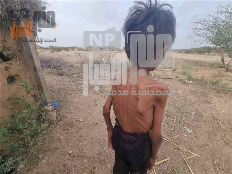 صرخة من مخيمات النزوح في حجة.. الجوع والمرض يفتكان بأسرة نازحة وسط صمت مؤلم(صور)
