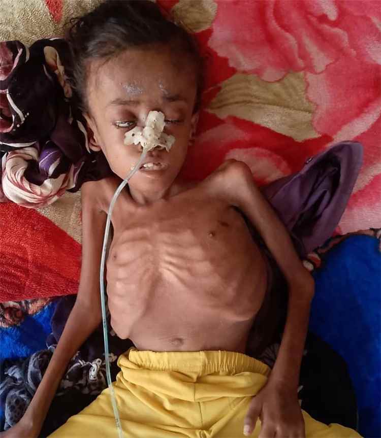 طفلة نازحة في حجة تواجه الموت بسبب المرض والجوع..