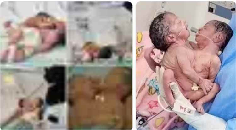 مركز الملك سلمان للإغاثة يتفاعل مع مناشدة إنقاذ توأم سيامي تمهيداً لإخلاء طبيهما.