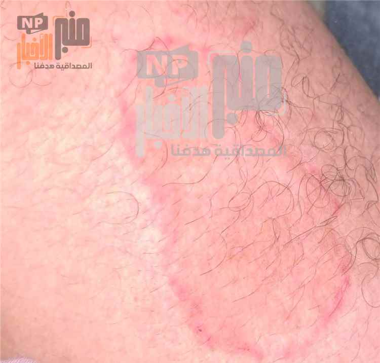 مخاوف من انتشار فطريات جلدية في المخا ومناطق الساحل.. مطالبات بتدخل صحي عاجل(صور)